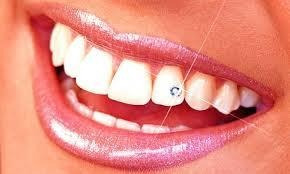 Imagen 2 de 3 de Piercing Dental En Córdoba