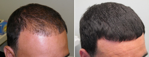 Loción Capilar Contra Calvicie Combo Formula Profesional