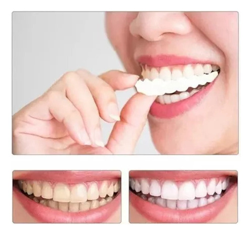 Facetas De Dentes Postiços De Sorriso Superior/inferior