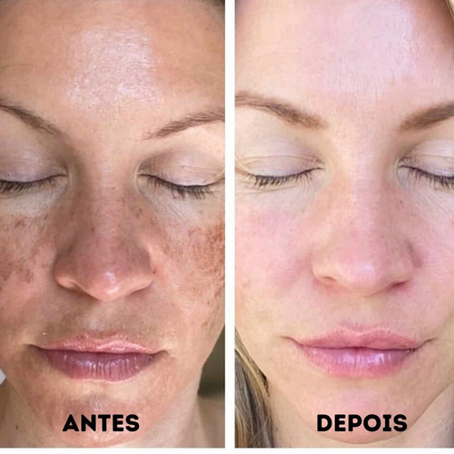 Imagem 5 de 6 de Serum Max Love Vitamina C E Acido Hialuronico
