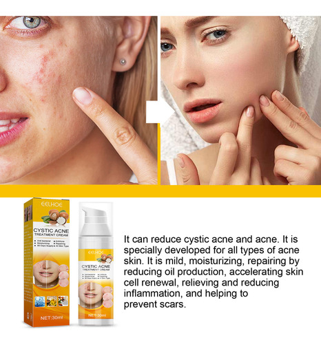 . Crema For Tratar El Acné: Combate El Acné Hormonal