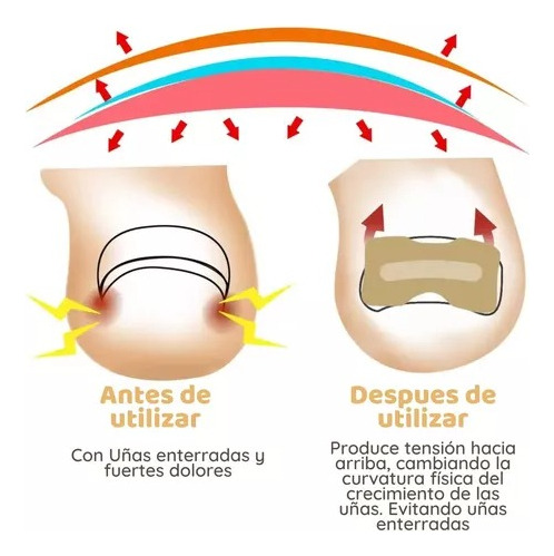 50 Parches Correctores Uñas Enterradas Uñeros Adhesivos