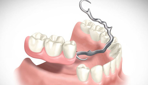Imagem 3 de 5 de Trabalho De Prótese Dentaria