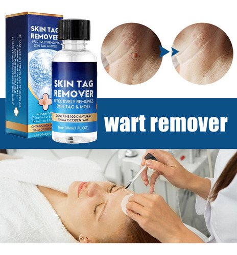 ~ Nitrógeno Líquido Antiwart, Eliminador De Moho