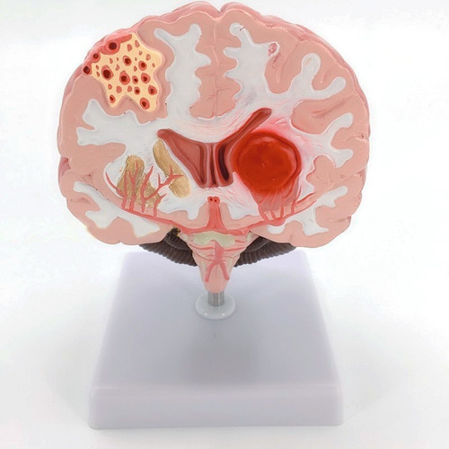 Modelo Anatómico De Cerebro Con Patologías, Medicina Educaci