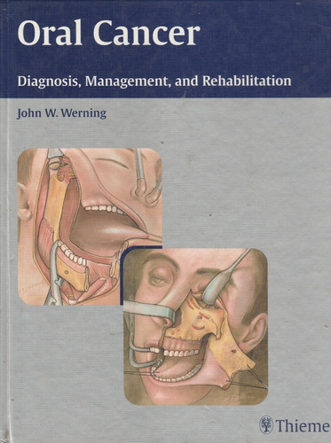 Oral Cancer Diagnosis, Management And Rehabilitation