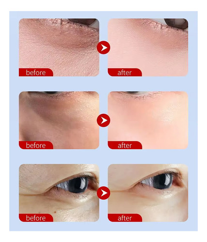 Set 2 Par Parche Colageno Remueve Bolsas De Los Ojos Ojeras Tipo De Piel Mixta