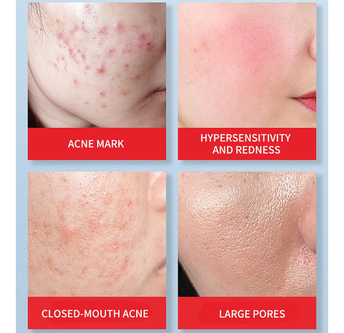 Gel Salicílico Atenuante De Remoção De Azelaico Para Impress