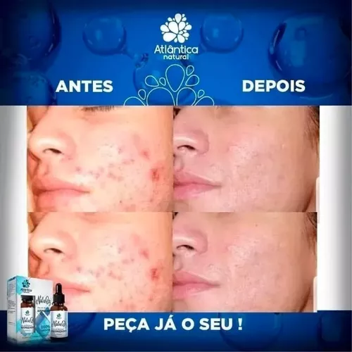 Natuoz óleo de Girassol ozonizado!#acne #tratamentopeleacneica #ozonio