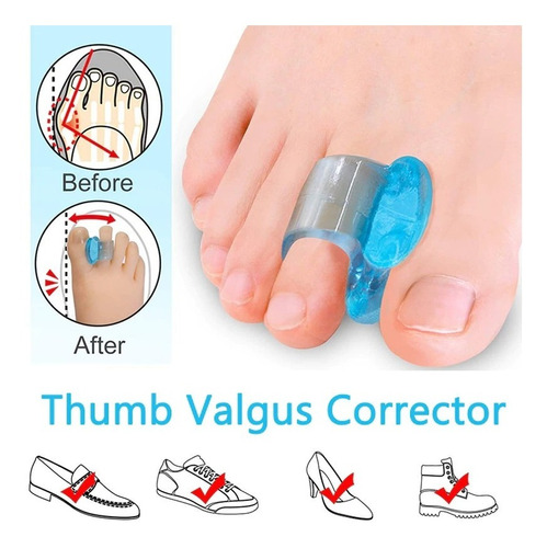 Corrector De Juanetes Hallux Valgus Separador (par) Azul