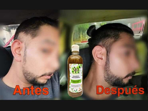 Pack De 3 Shampoos Siloe Contra Calvicie, Caspa, Alopecia.