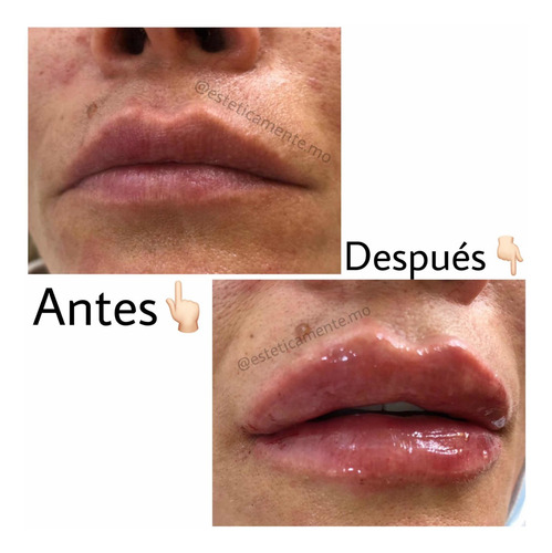 Imagen 4 de 5 de Relleno De Labios