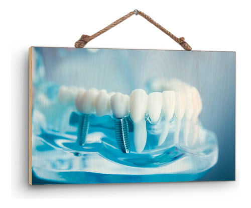 Cuadro De Madera Triplay Afiche Implante Dental 60x90cm