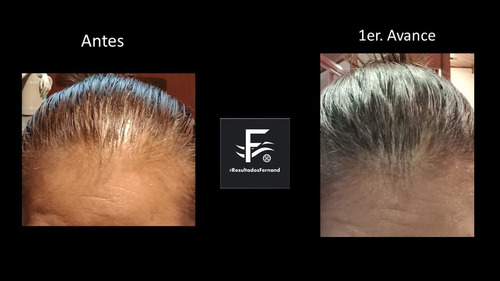 Solución Anticaida Para Hombre Con Cabello Con Caspa