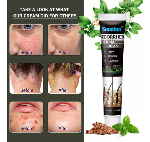 2 Piezas De Crema Para La Dermatitis Seborreica