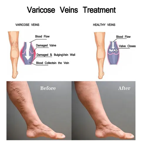 Crema Para Varices, 2 Unidades, 30 G, Tratamiento Para Espin
