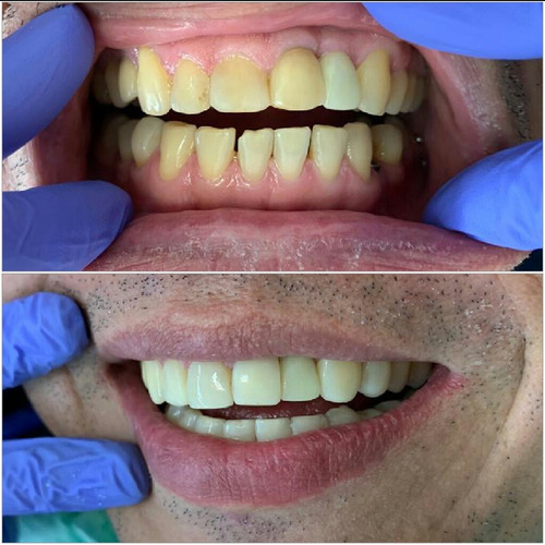 Carilla Dental En Composite O Resina