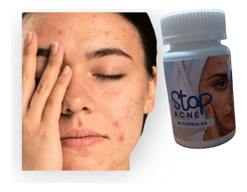 Stop Acne Formulacion Especifica Para El Acne 