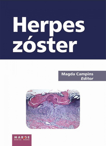 Herspes Zoster