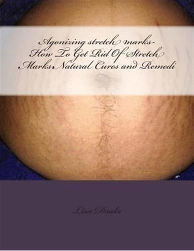 Agonizing Stretch Marks-how To Get Rid Of Stretch Marks -...