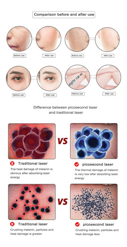 Neatcell Lápiz Láser Rojo Removedor De Manchas, Tatuajes