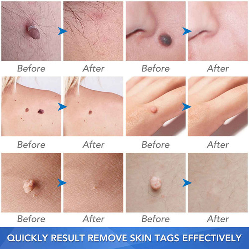 Micro Skin Tag Remover Kit De Eliminación De Etiquetas