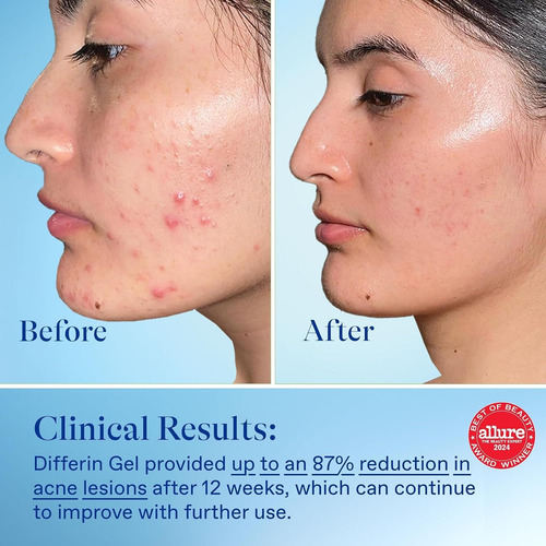 Differin Gel Pump 15gr Tratamiento Antiacné 0.1% 30 Días