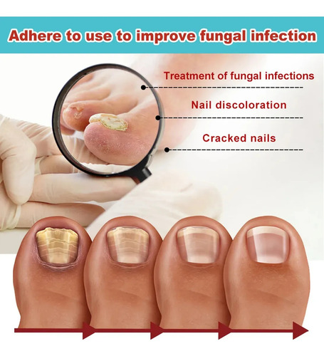 Adesivos De Unhas Noturnos Kerasal 2j Com Fungos, Restaura