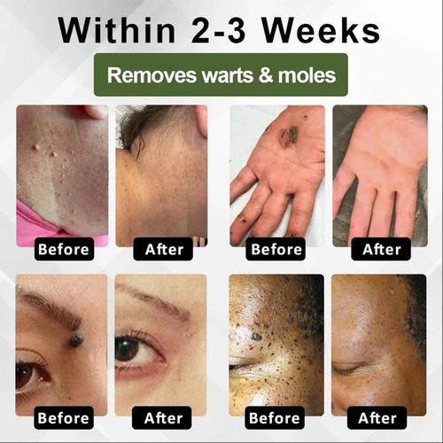 Gel Eliminador Instantáneo De Lunares Y Manchas, Gel Elimina