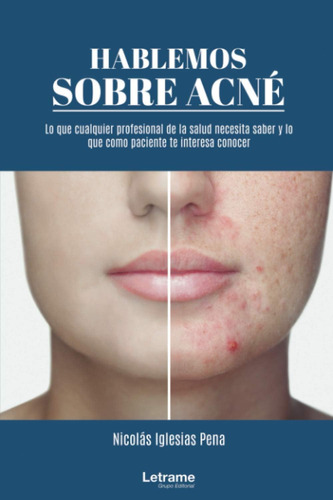 Libro: Hablemos Sobre Acné (spanish Edition)