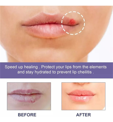 2 Parches Útiles Para Aliviar El Herpes Labial Y Curar La Di