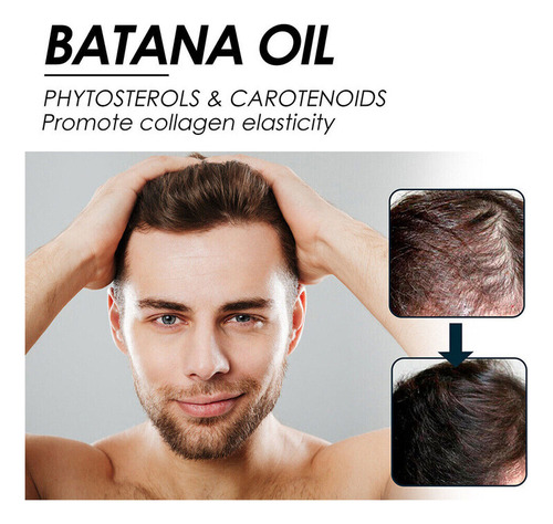 4 Botellas De Esencia Para El Crecimiento Del Cabello, Batan