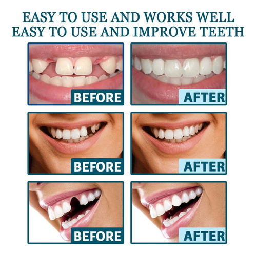 Wu Soportes Ajustables For Dentaduras Temporales Rellenos