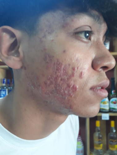 Jabón Facial Acne