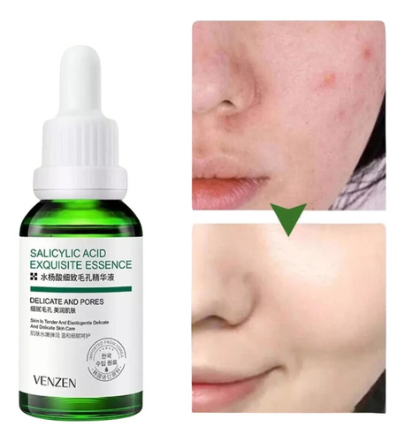 Liquido Antiacne Serum Reparador Espinillas Acido Salicilico