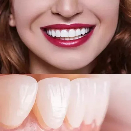 4box Carillas Dentales Ajustables Y Dentaduras Postizas