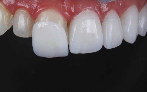 Imagem 1 de 3 de Facetas