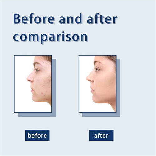 Loción Secante J Pimple De 30 Ml I Con Loción De Óxido I Par