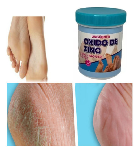 Oxido De Zinc Ungüento Frotación Para Pies 4 Unidades