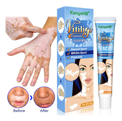 B5 Cuidado De La Piel Adulto Crema Hidratante Vitiligo Cream