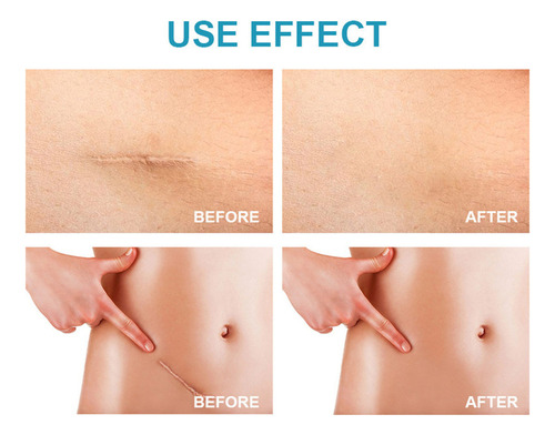 Gel Eliminador De Cicatrices Go For Queloides, Crema Repara