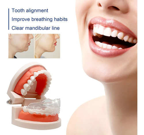 Alineación Mandibular De 3 Problemas, Solución: Pinza -