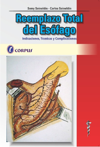 Reemplazo Total Del Esofago Corpus