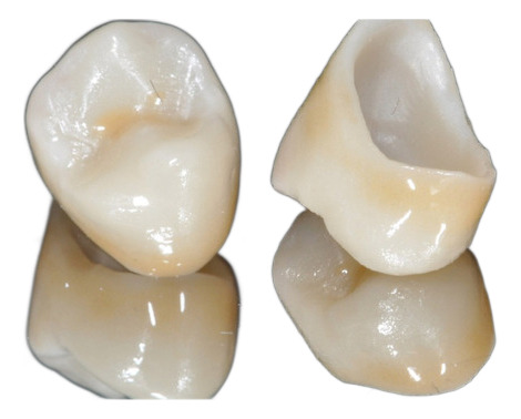 Corona Dental De Porcelana Tecnología Cad Cam