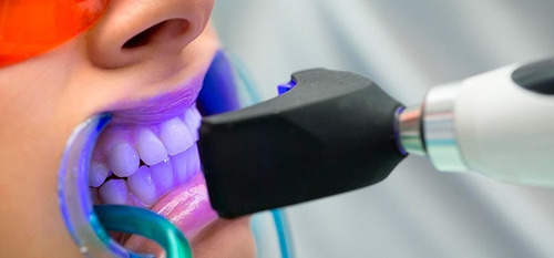 Imagen 3 de 3 de Blanqueamiento Profesional + Limpieza Dental