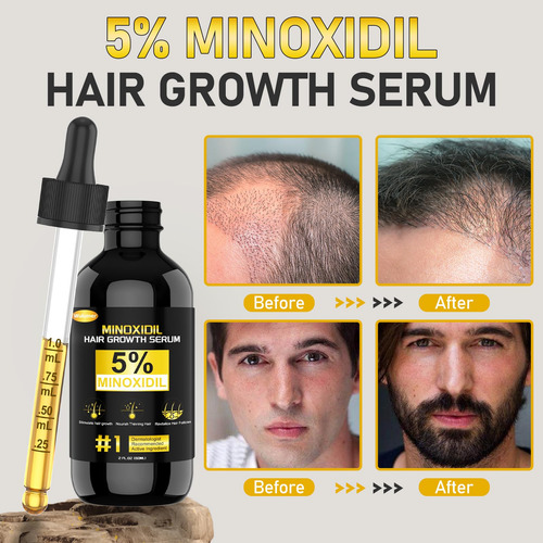 Tratamiento Anticaída Wulumer Minoxidil 5% Serum 60 Ml/2 Oz