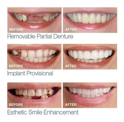 Imagen 1 de 5 de Sonrisa Perfecta Dentadura Dientes Blancos Relucientes Minut