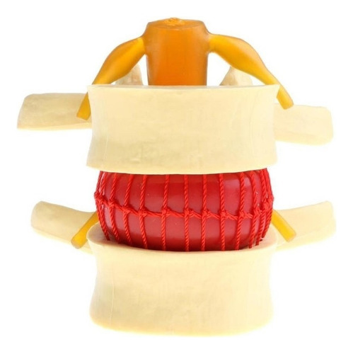 . 2x Modelo De Hernia De Disco Lumbar De La Columna