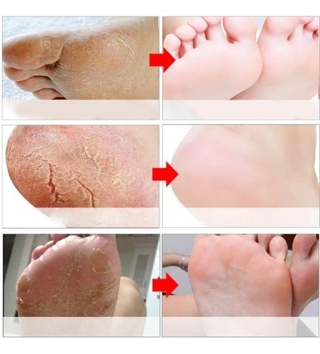 1 Par De Meia Esfoliante Tipo Foot Peeling Baby Foot