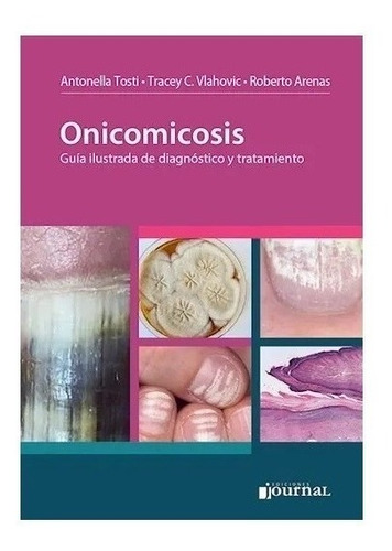 Onicomicosis 